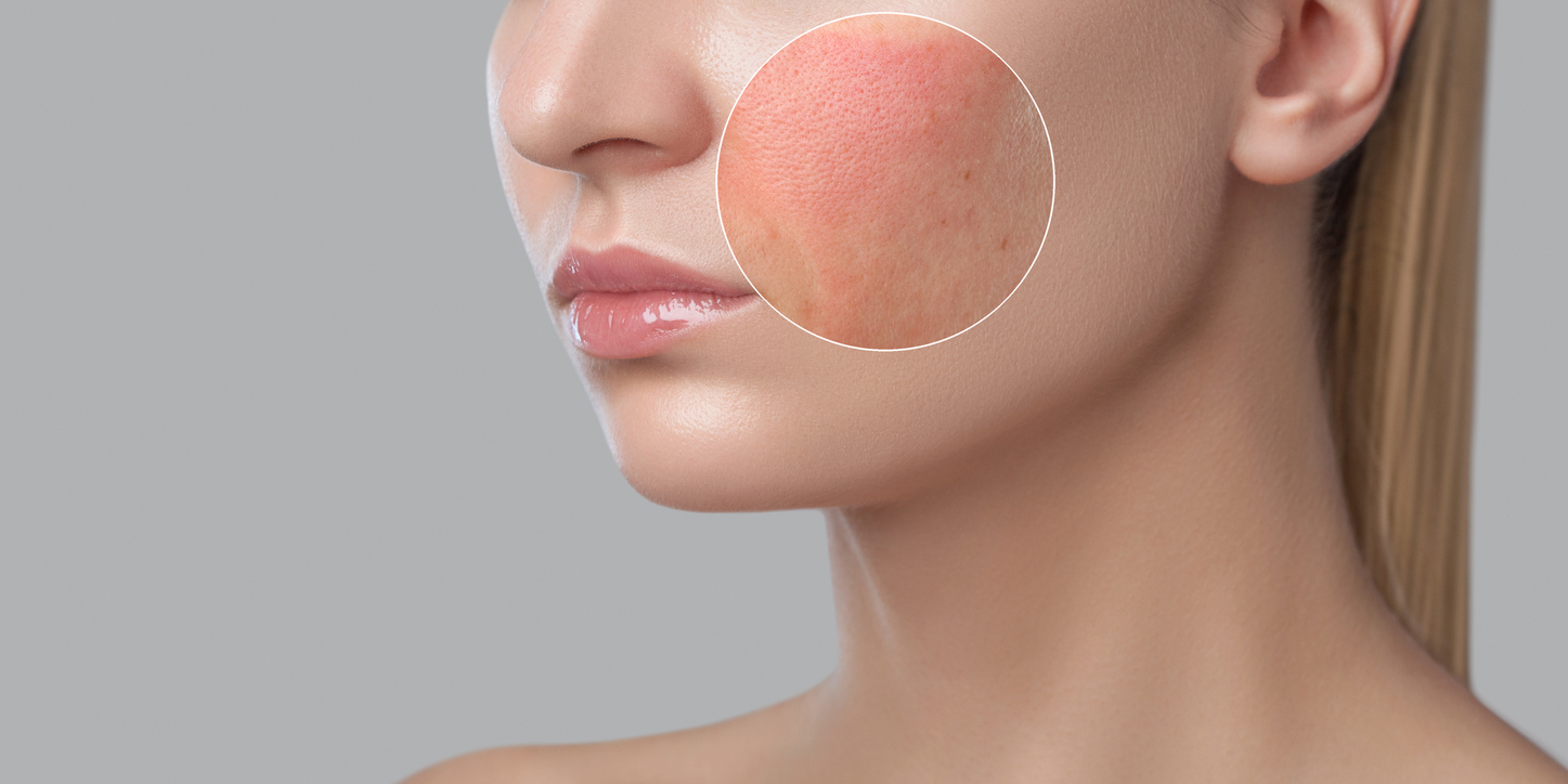 Ciri-Ciri di Muka / Wajah Alergi Kosmetik & Cara Mengatasinya