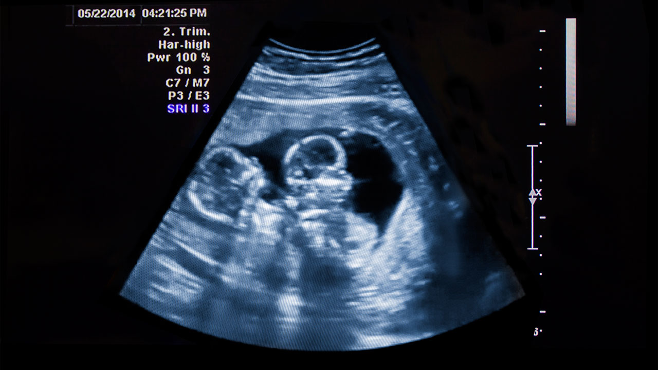 Ciri Hamil Anak Kembar 5 Ciri-Ciri & Tanda Hamil Anak Kembar: Apa Kamu Mengalaminya?