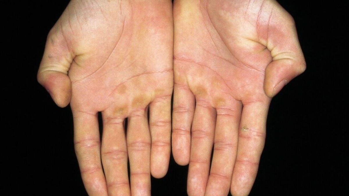 hiperpigmentasi kulit hiperpigmentasi adalah Apa itu hiperpigmentasi Bintik hitam di kulit Binitik hitam di tangan