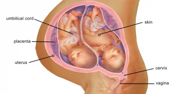 Ciri Hamil Anak Kembar 5 Ciri-Ciri & Tanda Hamil Anak Kembar: Apa Kamu Mengalaminya?