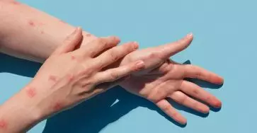 gejala cacar monyet