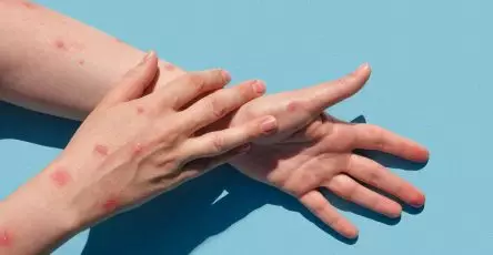 gejala cacar monyet