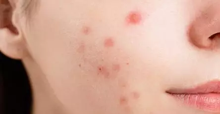 Penyebab jerawat di pipi Cara mengatasi jerawat di pipi jerawat di pipi jerawat merah di pipi jerawat meradang di pipi