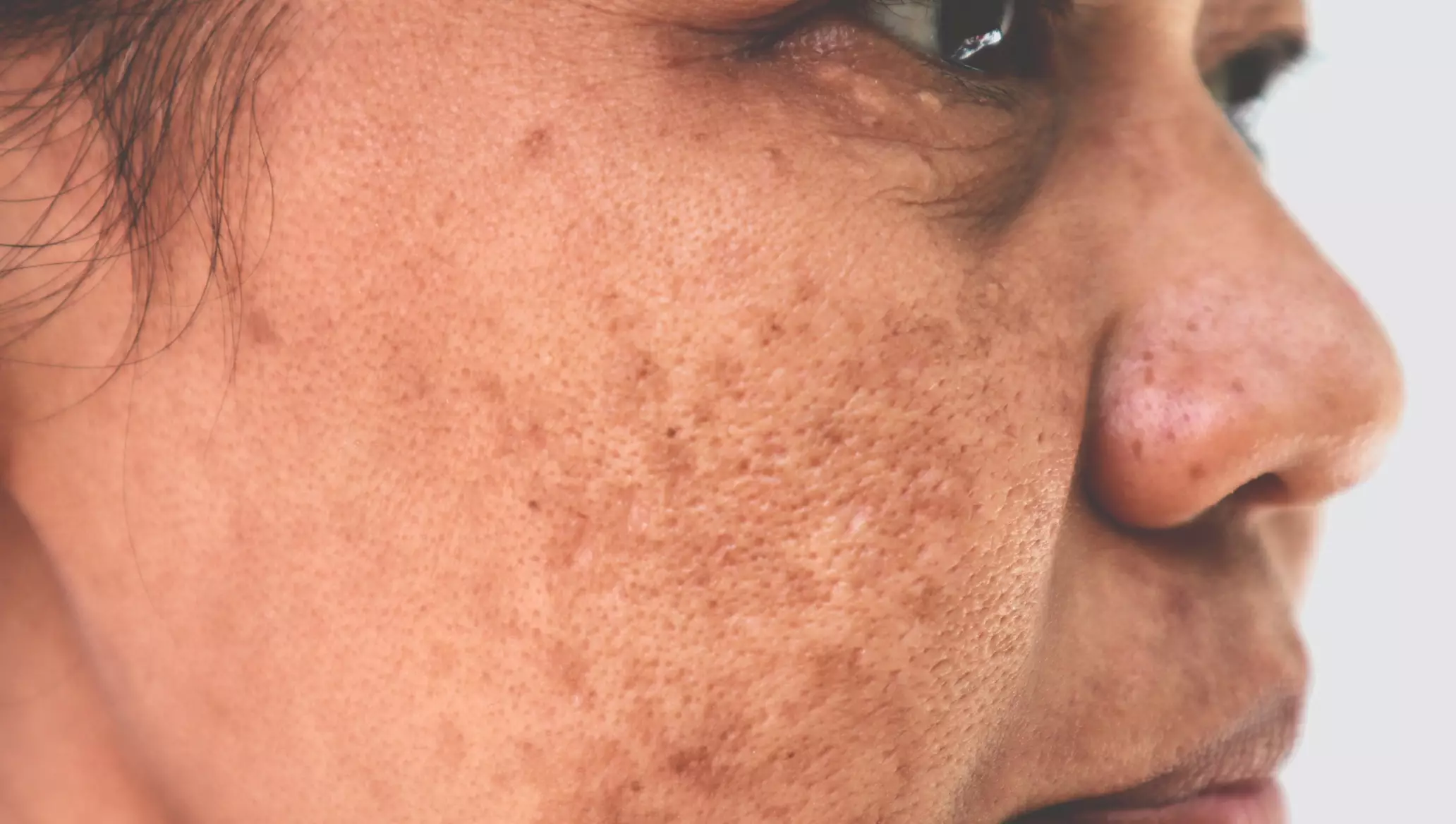 hiperpigmentasi kulit hiperpigmentasi adalah Apa itu hiperpigmentasi Bintik hitam di kulit Binitik hitam di tangan
