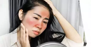 ciri-ciri wajah yang terkena merkuri